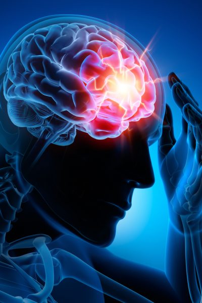 Severe Headache - Migraine - Medical Illustration - 3D Rendering